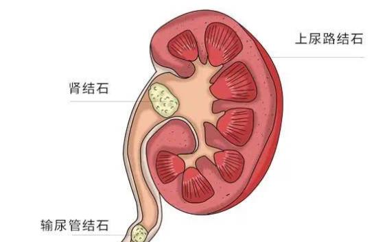 腎結(jié)石在腎里能打嗎 腎結(jié)石在腎里如何排出