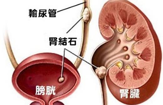 腎結(jié)石做什么手術(shù)好 腎結(jié)石發(fā)燒吃什么藥