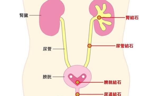 著涼會引起腎結(jié)石嗎 腎結(jié)石怕著涼嗎