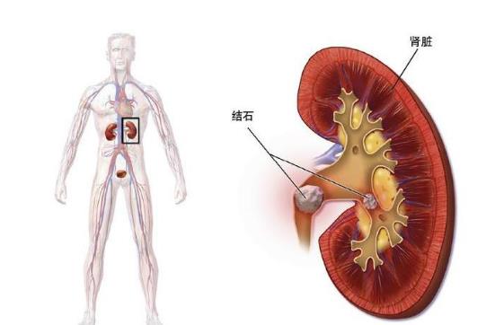 腎結(jié)石小便出血嚴重嗎 腎結(jié)石發(fā)炎嚴重嗎