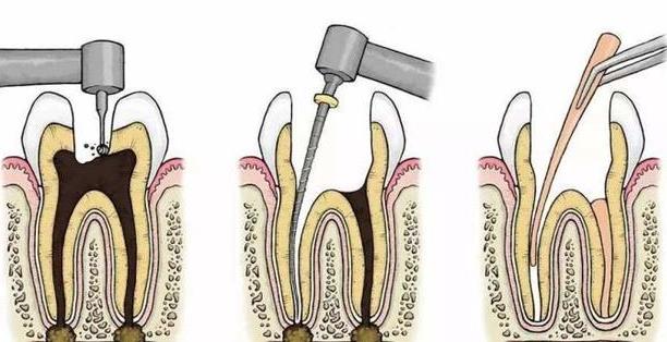 牙齒做根管治療貴嗎 二次根管治療費(fèi)用比第一次貴嗎