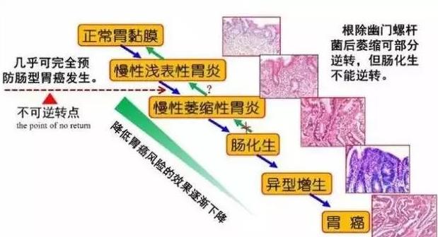 萎縮性胃炎中度嚴重嗎 中度萎縮性胃炎伴中度腸化嚴重嗎