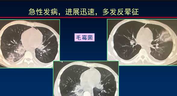 肺部長(zhǎng)霉菌能治好嗎 肺部霉菌感染怎么辦