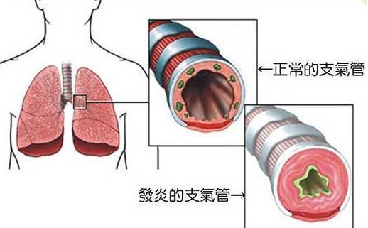 慢性支氣管炎嚴重嗎 支氣管炎嚴重嗎