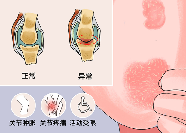 銀屑病患者可以洗澡嗎 銀屑病患者可以泡溫泉嗎