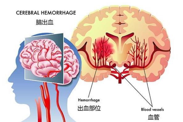 腦出血怎么急救 血壓多少會(huì)腦出血