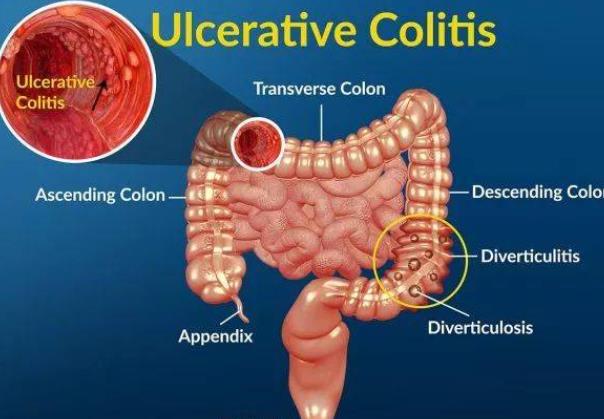 結腸炎能根治嗎 結腸炎怎么徹底治好