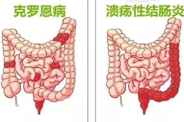 結(jié)腸炎是哪里疼 結(jié)腸炎怎么確診