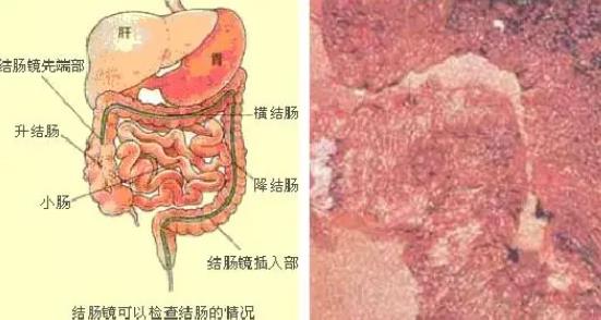 結腸炎能自愈嗎 結腸炎怎么調理