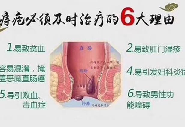 哪種痔瘡膏效果最好 怎么讓痔瘡肉球縮回去