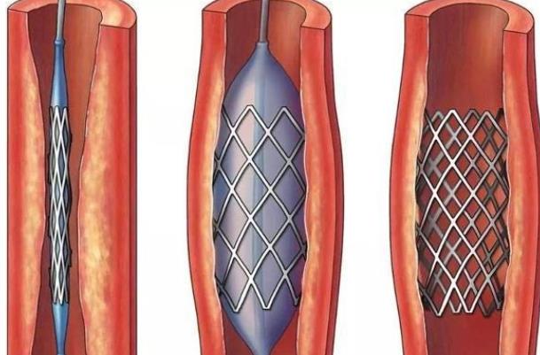 心臟支架有哪些利與弊 心臟支架有效期多久